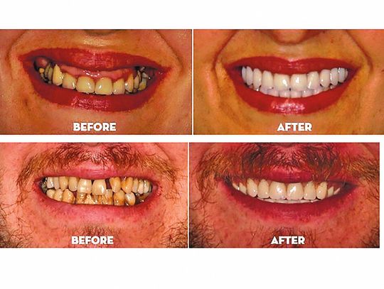 Chwiejące się zęby? Protezy, które się ruszają? Istnieje trwałe rozwiązanie, które może odmienić Twoje życie