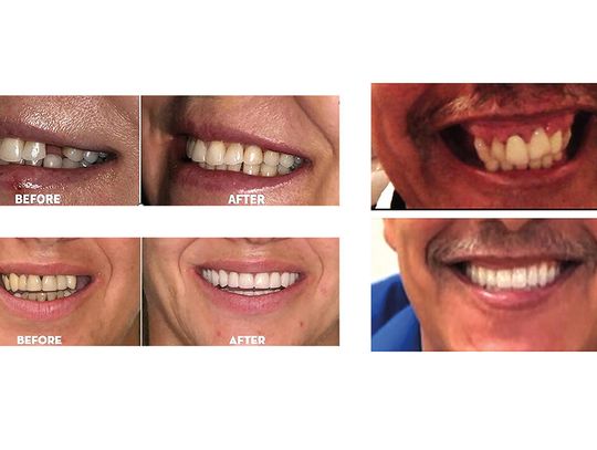 Czy implanty dentystyczne są bezpieczne? Tego nie zobaczysz w mediach społecznościowych