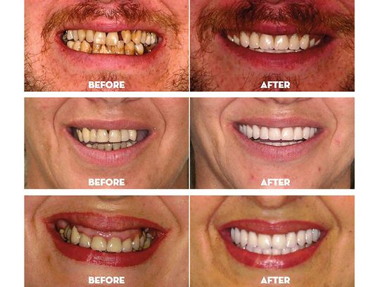 Druga szansa na uśmiech na całe życie: metamorfoza All-on-X