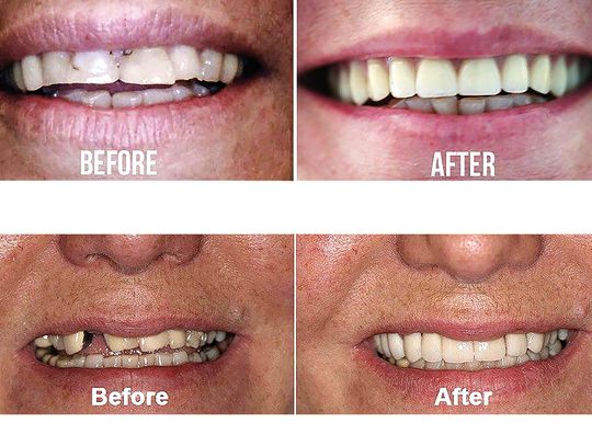 Leczenie próchnicy bez borowania