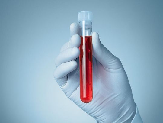 Nowy test krwi określa ryzyko rozwoju choroby Alzheimera u osób zdrowych
