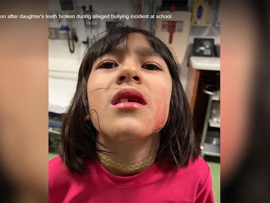 Ośmiolatka ofiarą bullyinyu w chicagowskiej szkole, ma wybite zęby