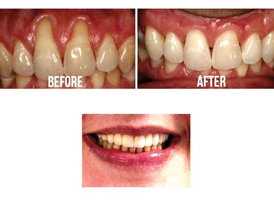 Recesja dziąseł – co trzeba wiedzieć