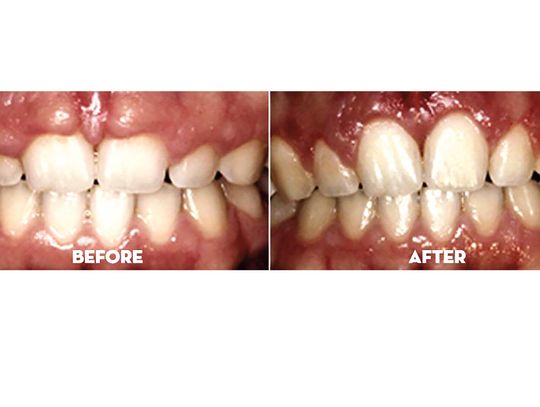 Skuteczne metody leczenia chorób przyzębia