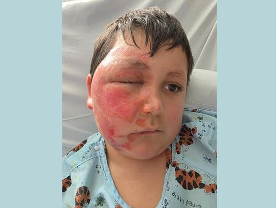 Uwaga na trend na TokToku: 9-latek z poparzeniami twarzy po wybuchu popularnej zabawki