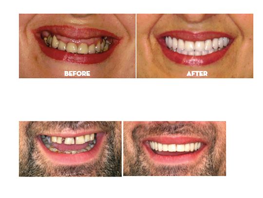 Zakończone leczenie zębów lub implantów — jak mogę chronić inwestycję w mój uśmiech?