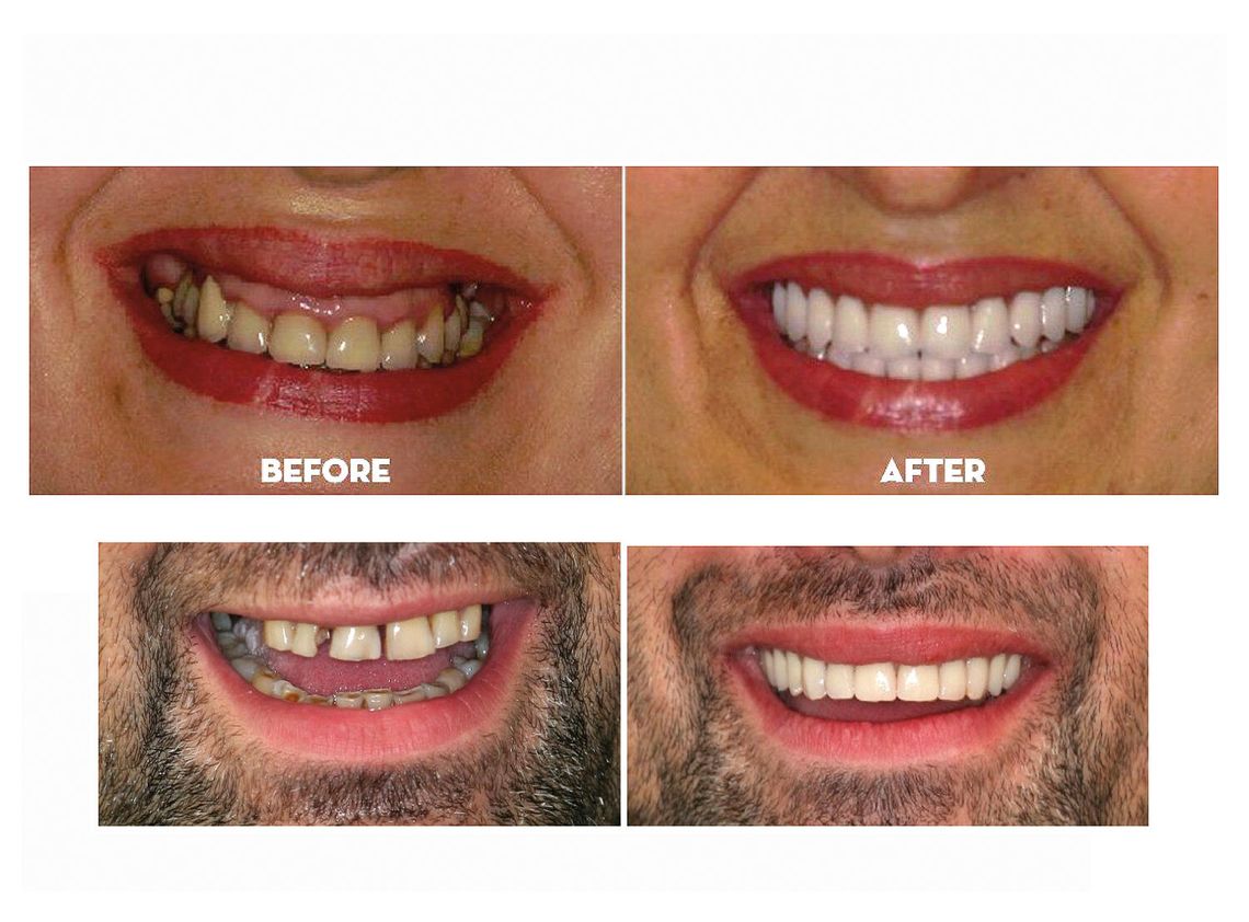 All on X i All on 4 – metody uzupełnienia brakujących zębów