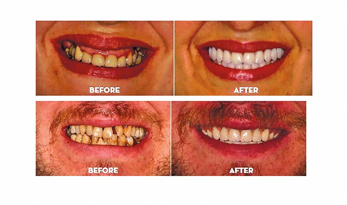 Chwiejące się zęby? Protezy, które się ruszają? Istnieje trwałe rozwiązanie, które może odmienić Twoje życie