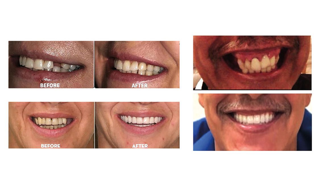 Czy implanty dentystyczne są bezpieczne? Tego nie zobaczysz w mediach społecznościowych