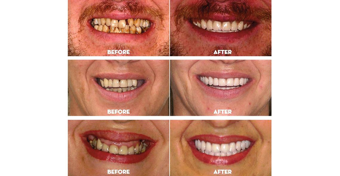 Druga szansa na uśmiech na całe życie: metamorfoza All-on-X Druga szansa na uśmiech na całe życie: metamorfoza All-on-X