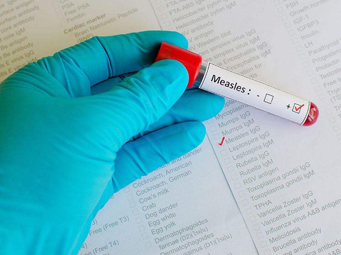 Kwarantanna w ośrodku detencyjnym ICE w Teksasie z powodu odry