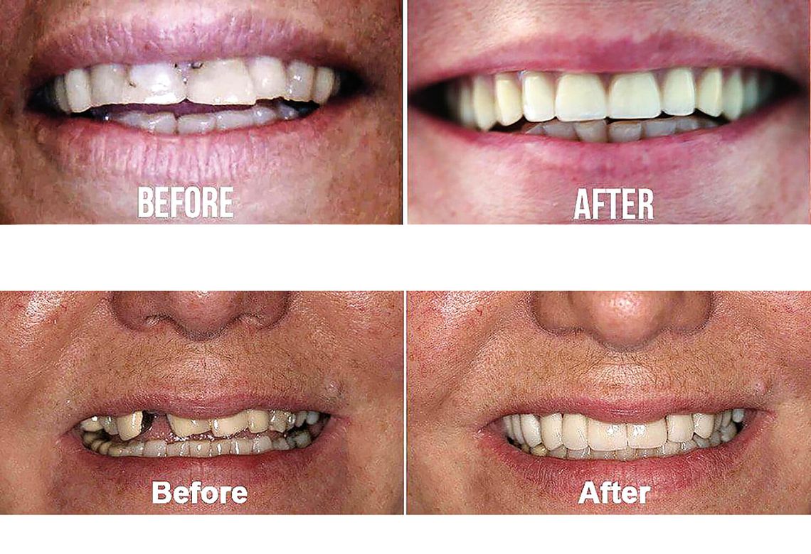 Leczenie próchnicy bez borowania