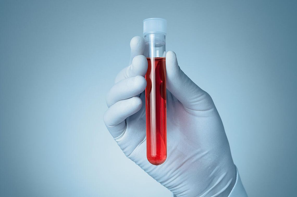 Nowy test krwi określa ryzyko rozwoju choroby Alzheimera u osób zdrowych Nowy test krwi określa ryzyko rozwoju choroby Alzheimera u osób zdrowych