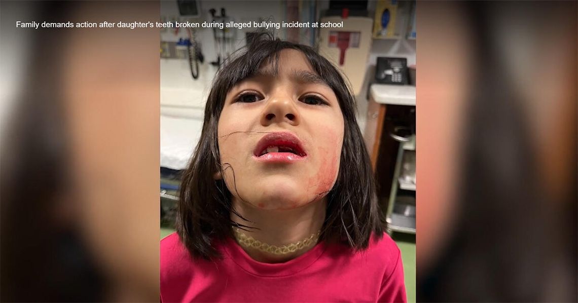 Ośmiolatka ofiarą bullyinyu w chicagowskiej szkole, ma wybite zęby