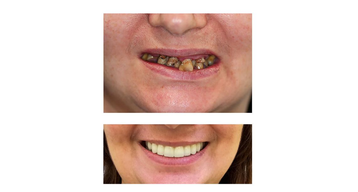Prawdy i mity dotyczące implantów dentystycznych