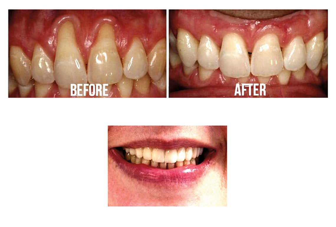 Recesja dziąseł – co trzeba wiedzieć