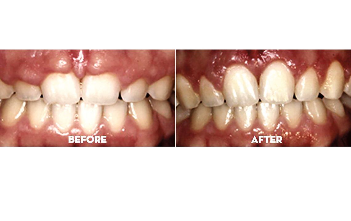 Skuteczne metody leczenia chorób przyzębia