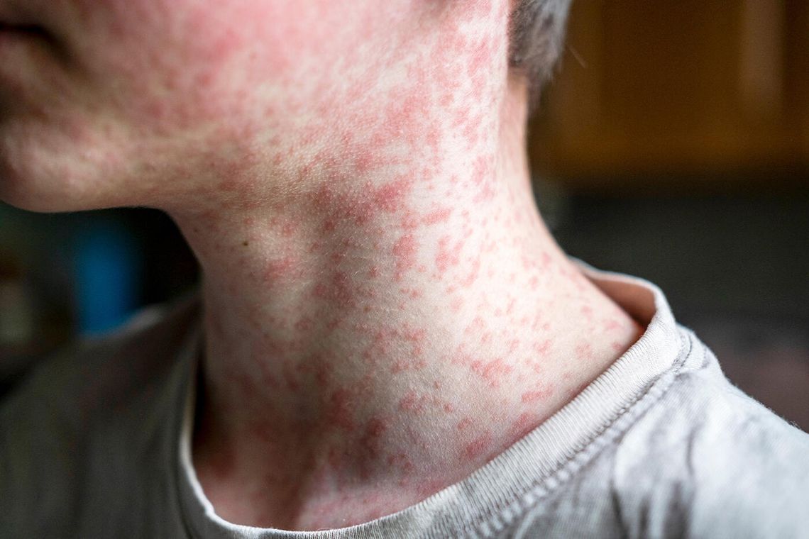 W Teksasie nasila się epidemia odry