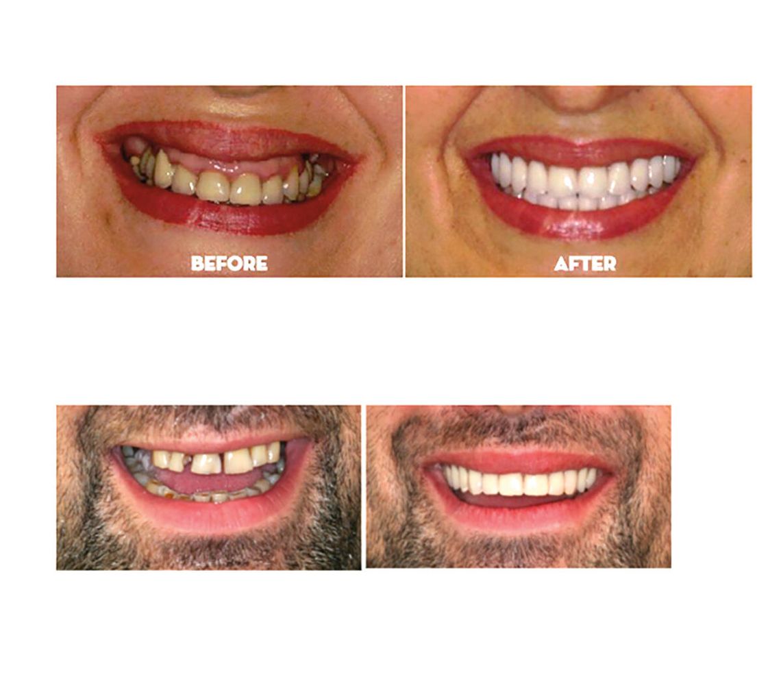 Zakończone leczenie zębów lub implantów — jak mogę chronić inwestycję w mój uśmiech?