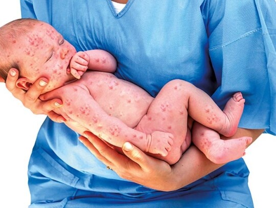 Doctor holding a newborn baby which is sick rubella or measles